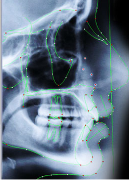 3D Ceph Analis 3D Ceph Analis